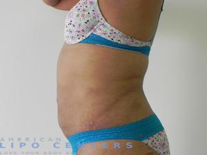 americanlipocenters_22.jpg